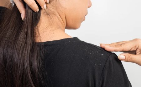 Cara Menghilangkan Ketombe Berkerak di Kepala yang Alami